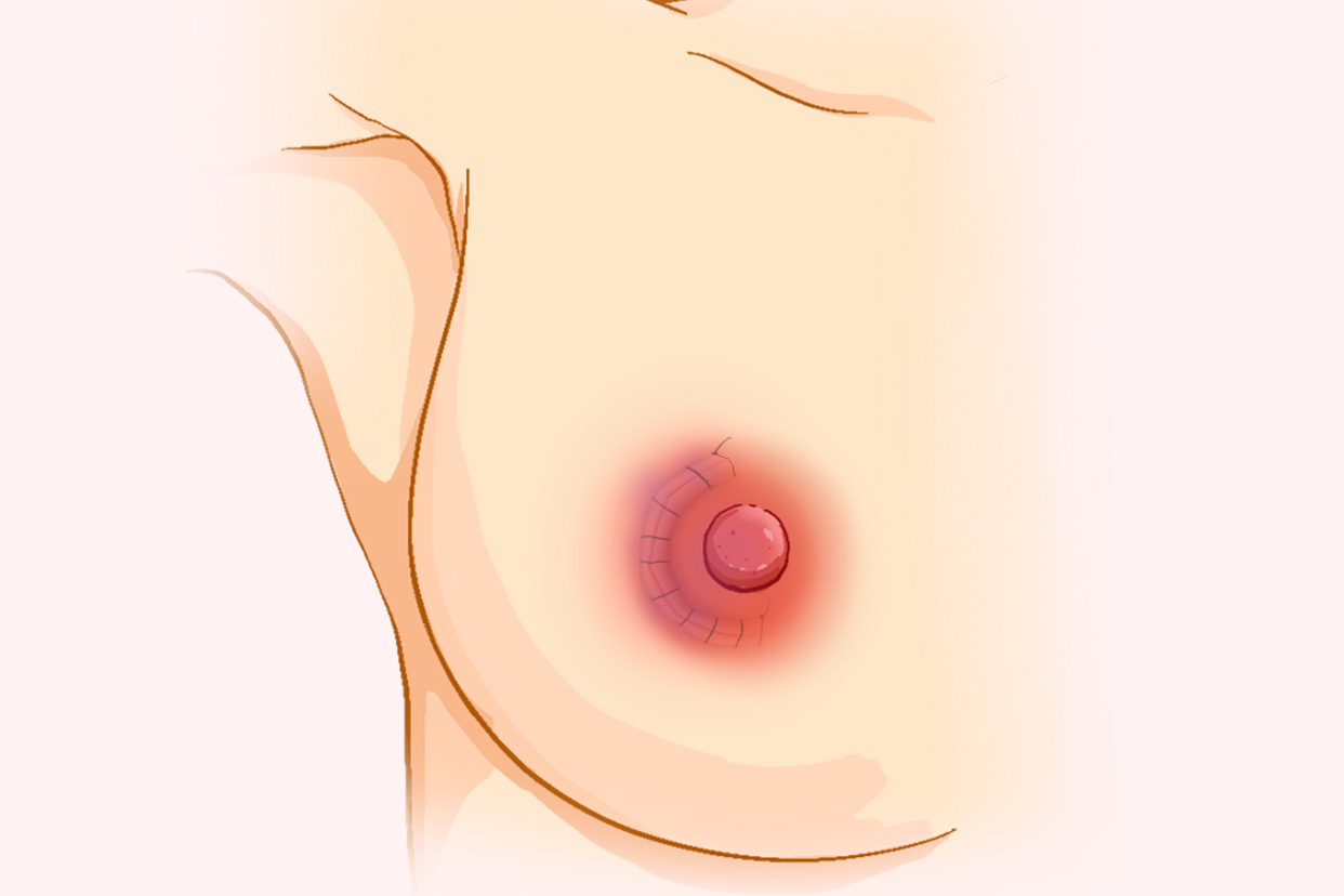 浆乳手术后的疤痕图片（浆乳手术后的疤痕图片大全）