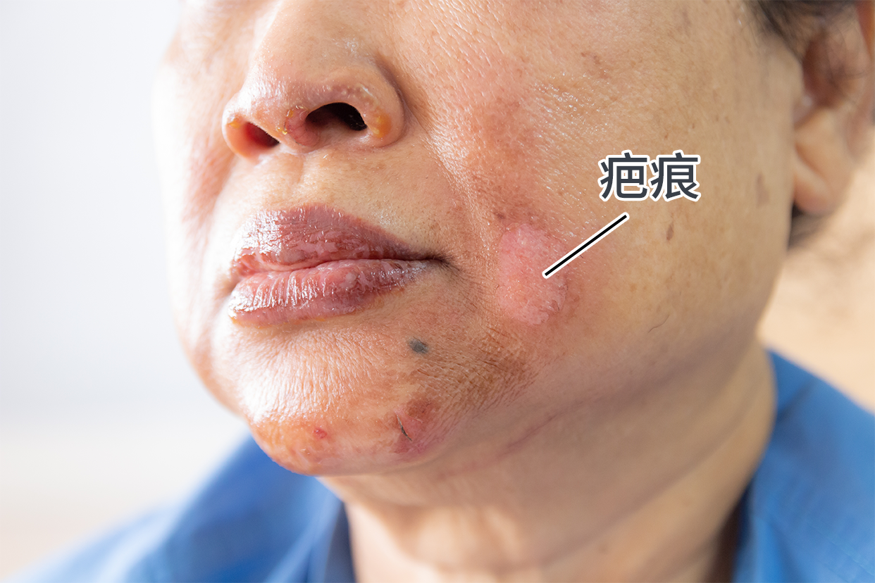脸上烫伤后疤痕形成初期图片 脸部烫伤后的疤痕图片