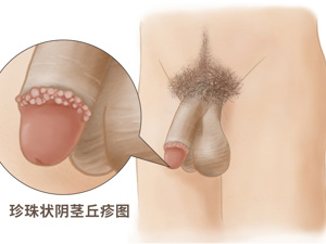 冠状沟皮脂腺异位图片 皮脂腺异位典型图片
