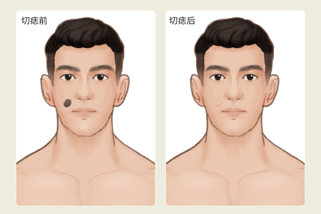 切痣前后对比照片 手术切痣前后对比