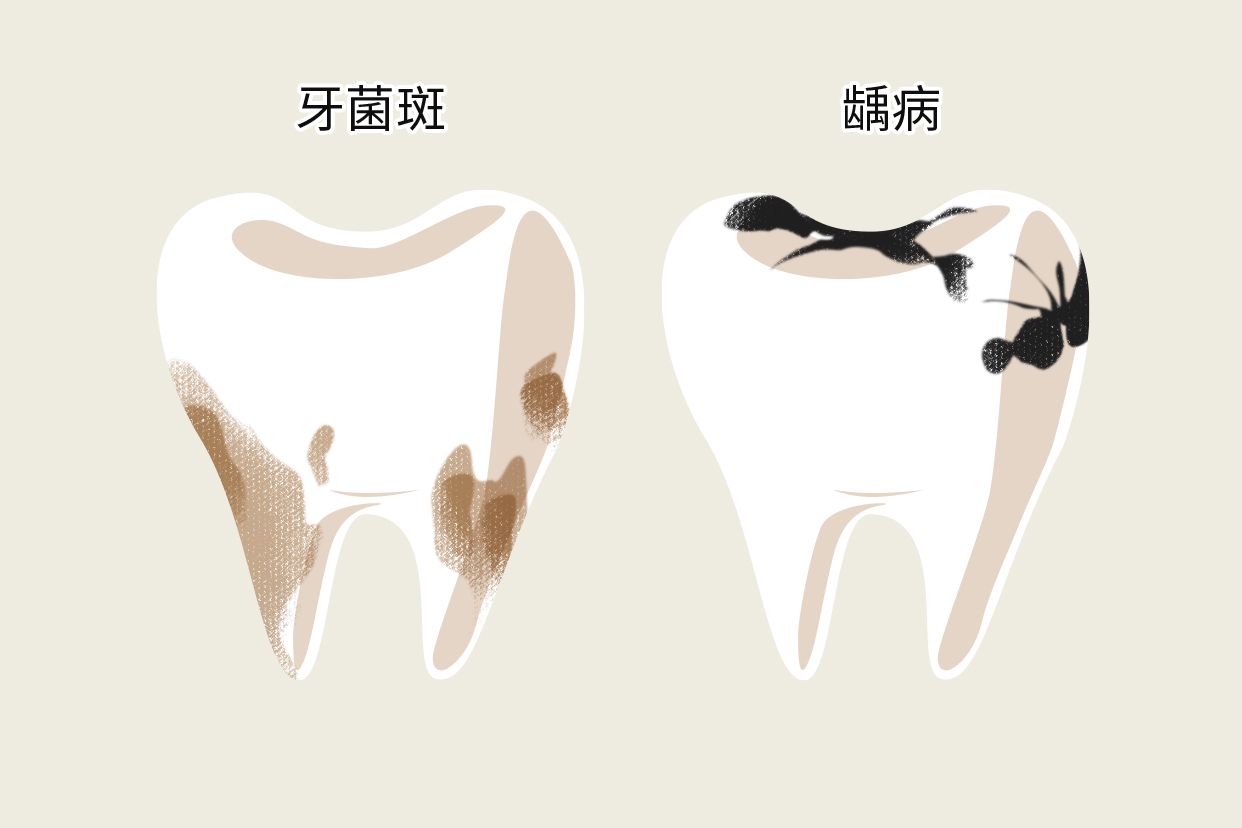 牙垢和蛀牙的区别图片 牙垢和蛀牙的区别图片