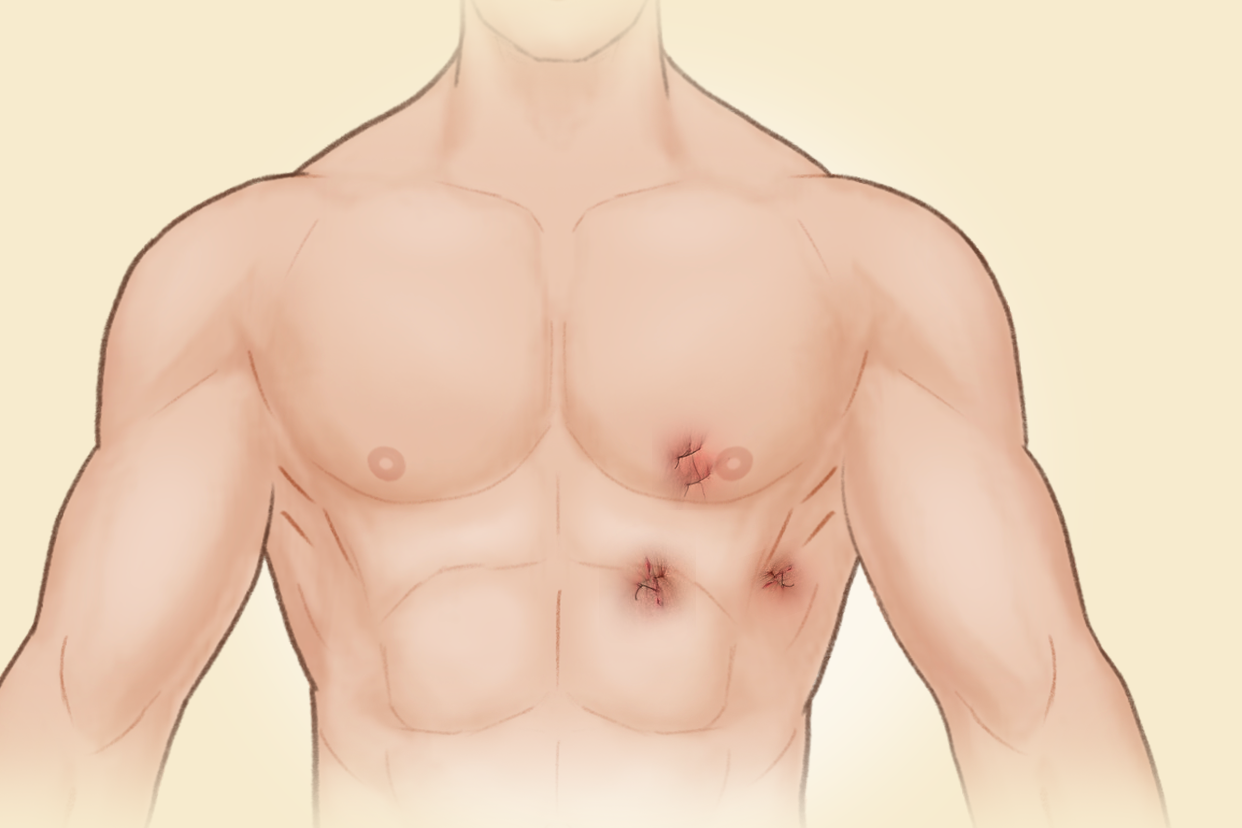 心包囊肿微创手术后伤疤图片