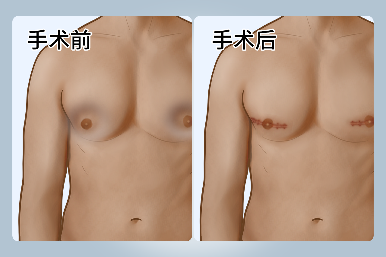 男性乳房手术后凹陷填充图片