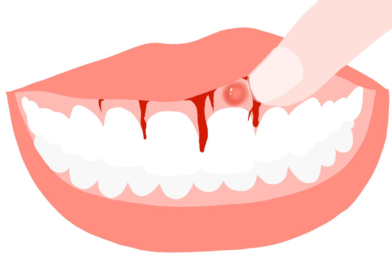 慢性重金属中毒牙龈图