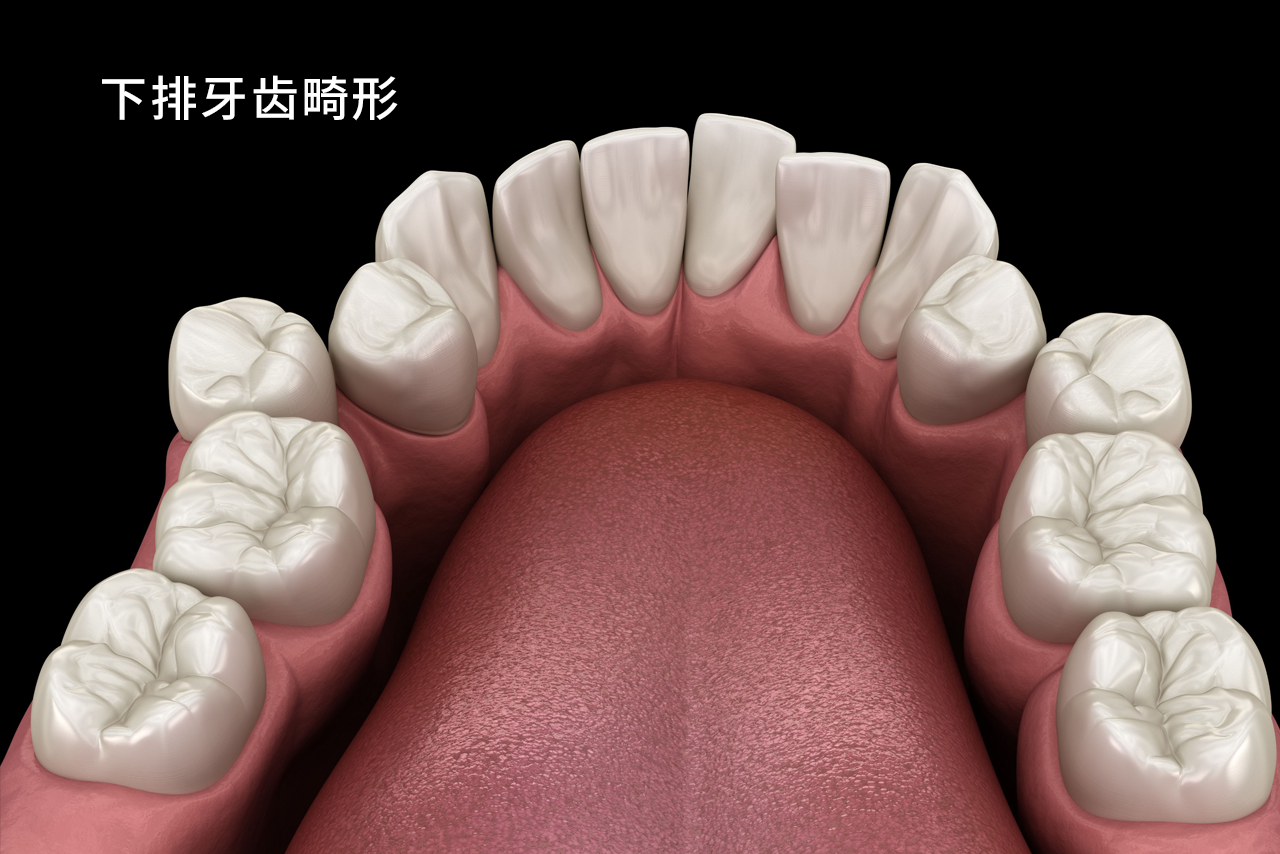 下排牙齿畸形图