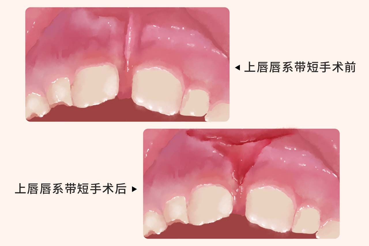 上唇唇系带短手术后图