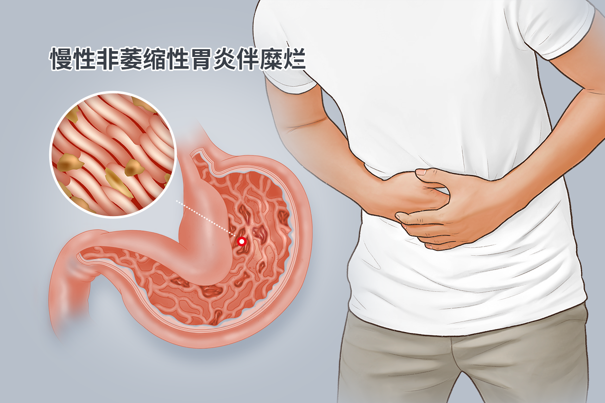 慢性非萎缩性胃炎伴糜烂图片 慢性非萎缩性胃炎伴糜烂图片高清