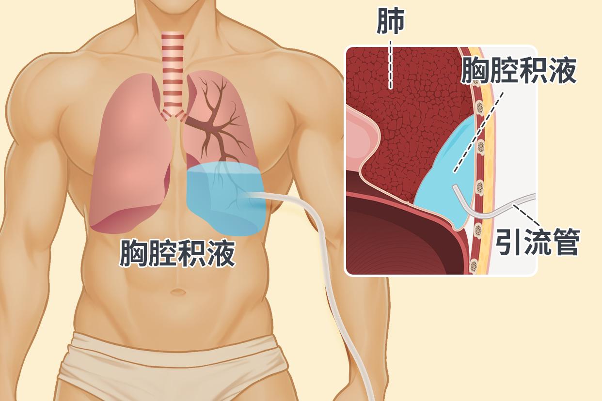 胸膜炎伤口引流管的位置图片 胸膜炎伤口引流管的位置图片及视频