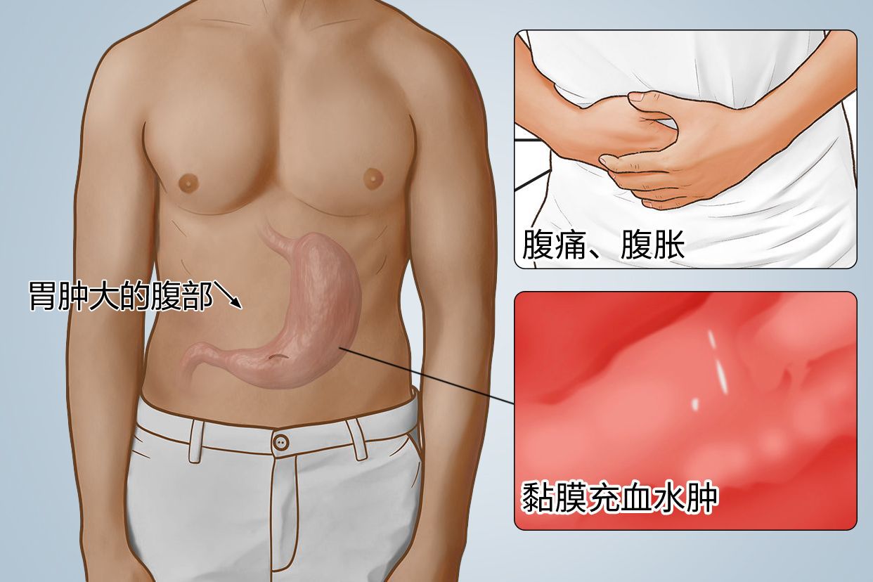 胃肿大的腹部图片 胃肿大严重吗