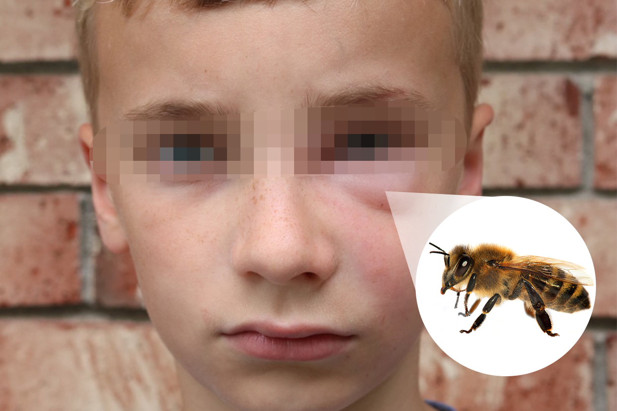 小孩被蜜蜂蛰了肿图片 小孩被蜜蜂蛰了怎么消肿止痒