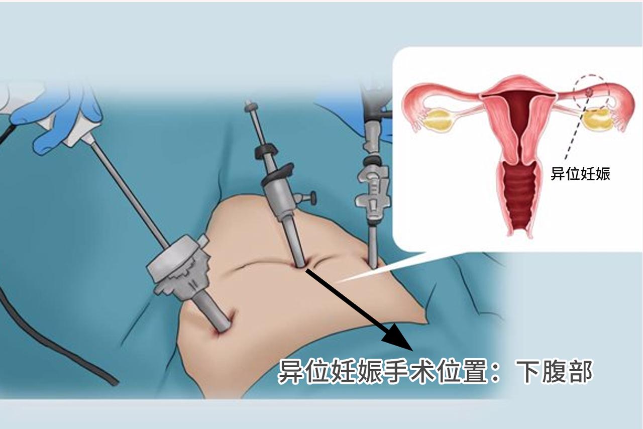 宫外孕手术在哪里开刀图 宫外孕手术从哪开刀