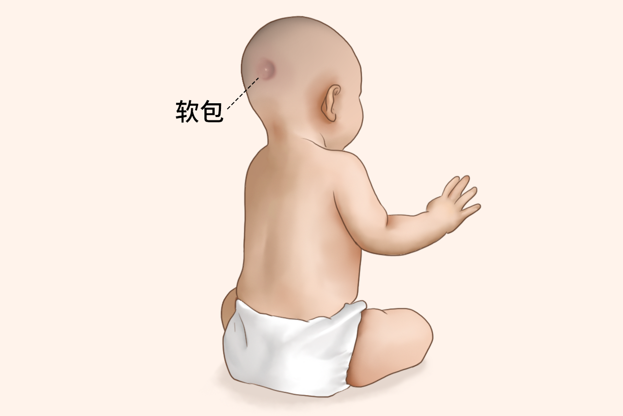 6个月婴儿后脑有个软包图片 六个月宝宝后脑有个硬包