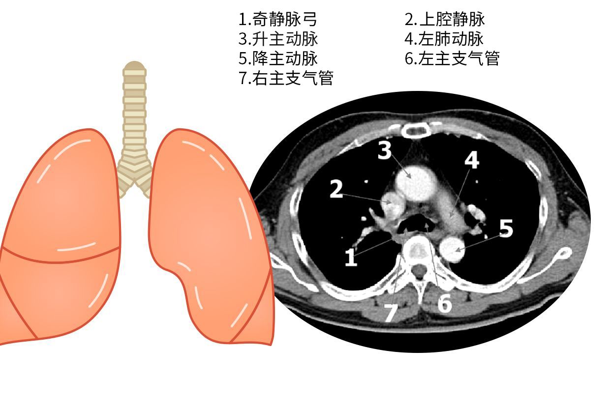 主动脉肺动脉窗图片 主动脉肺动脉窗ct图片