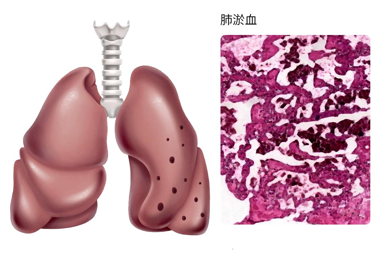 肺淤血图片 肺淤血图片及各部分结构