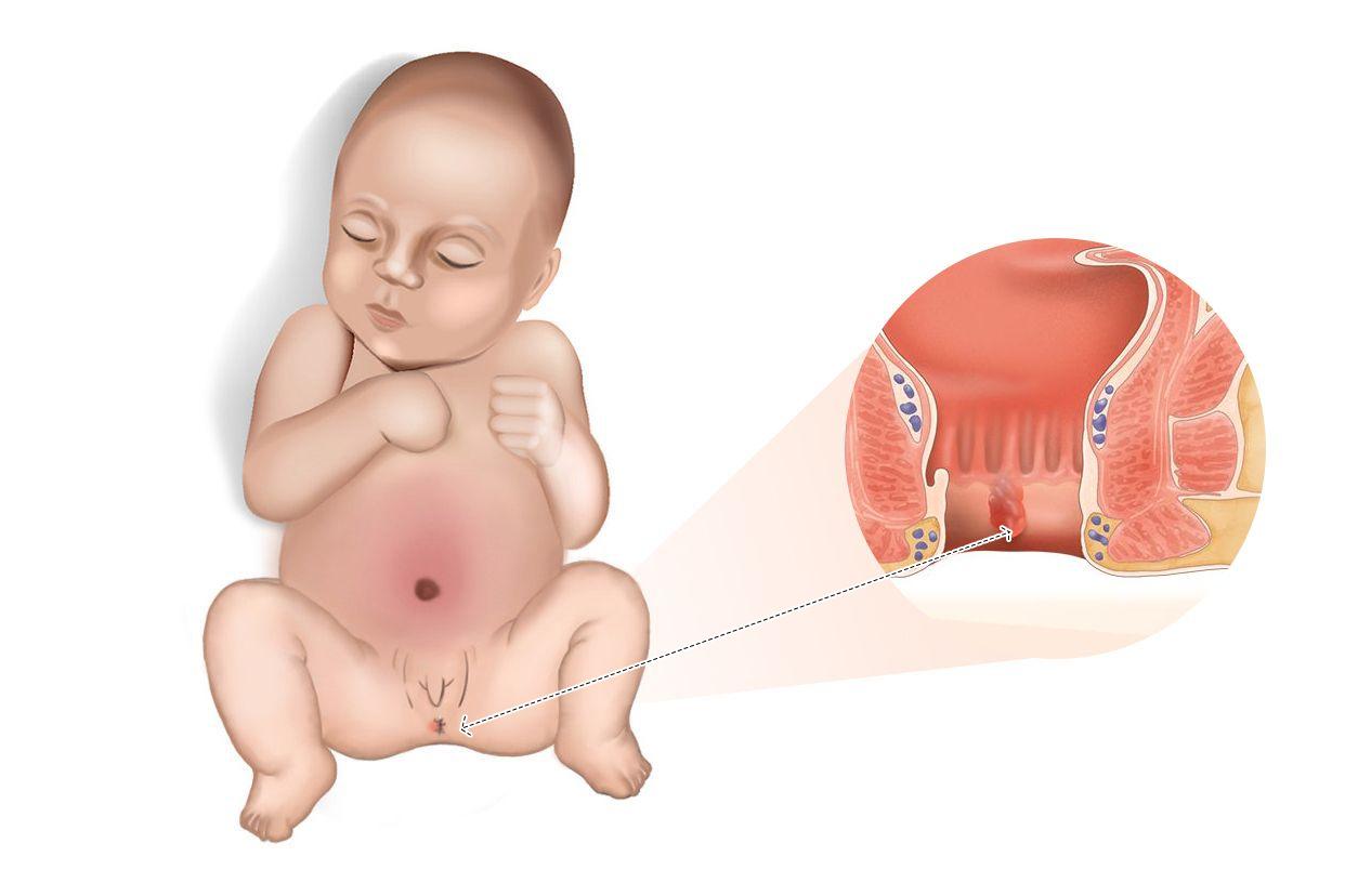 三个月婴儿肛门有肉疙瘩图片（三个月婴儿肛门有肉疙瘩图片怎么回事）