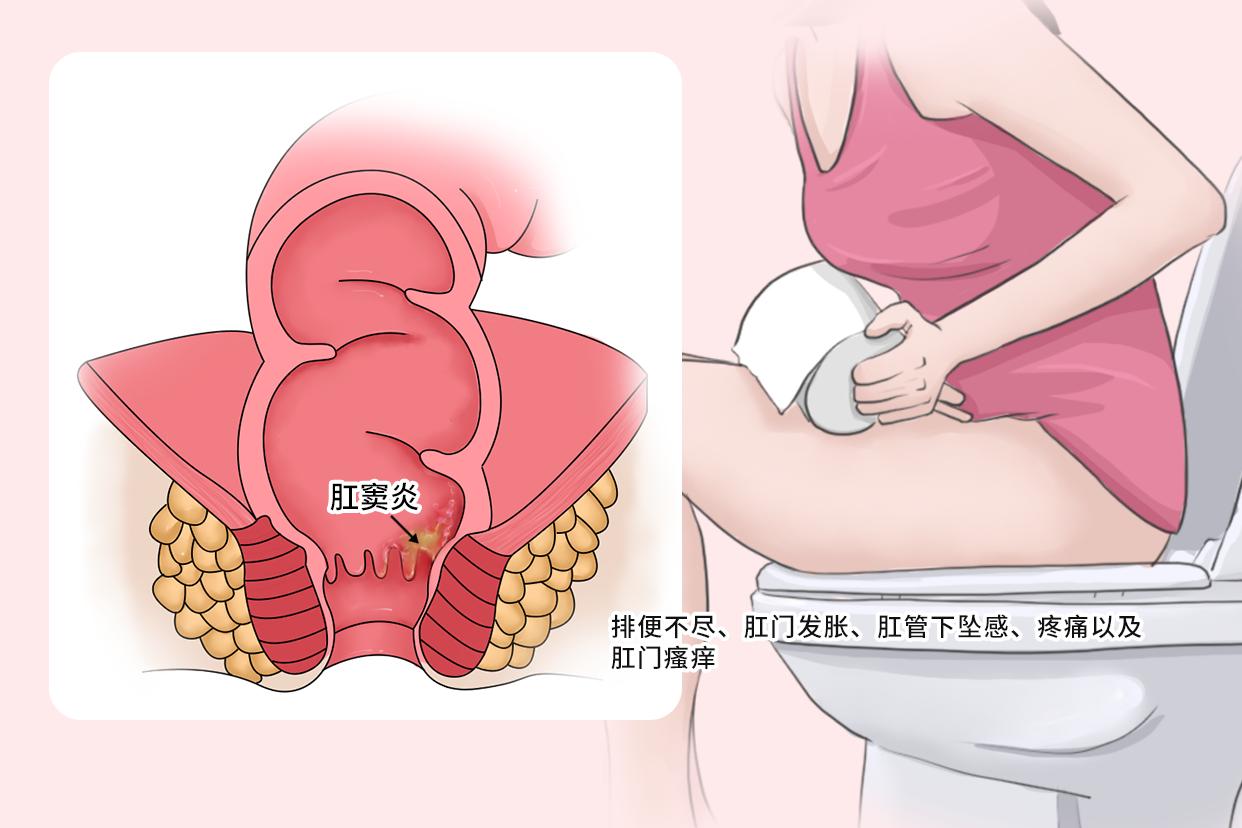 女性肛窦炎的症状图片 肛窦炎会发展成什么病
