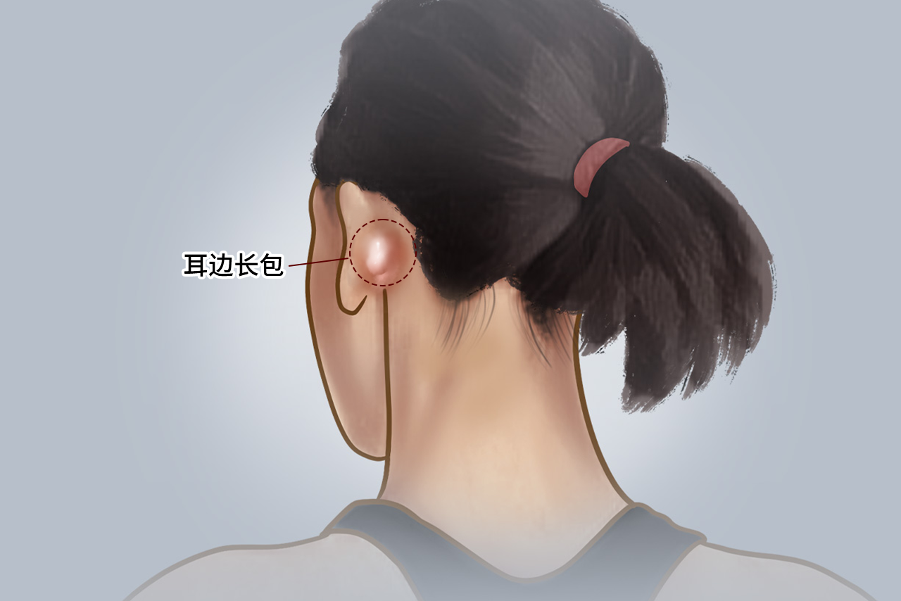 淋巴癌耳边长包图片 淋巴癌在耳朵前还是耳朵后