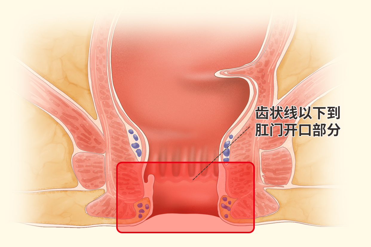 肛管癌位置图片 肛管癌的位置