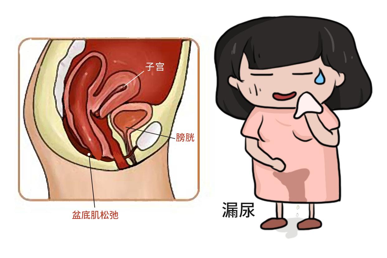 盆底肌松弛漏尿图片（盆底肌松弛漏尿图片女性）