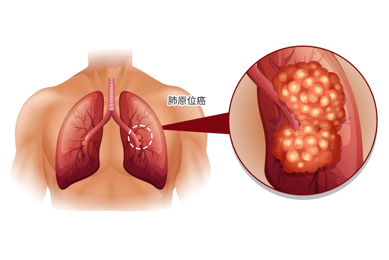 肺原位癌图 肺原位癌临床表现