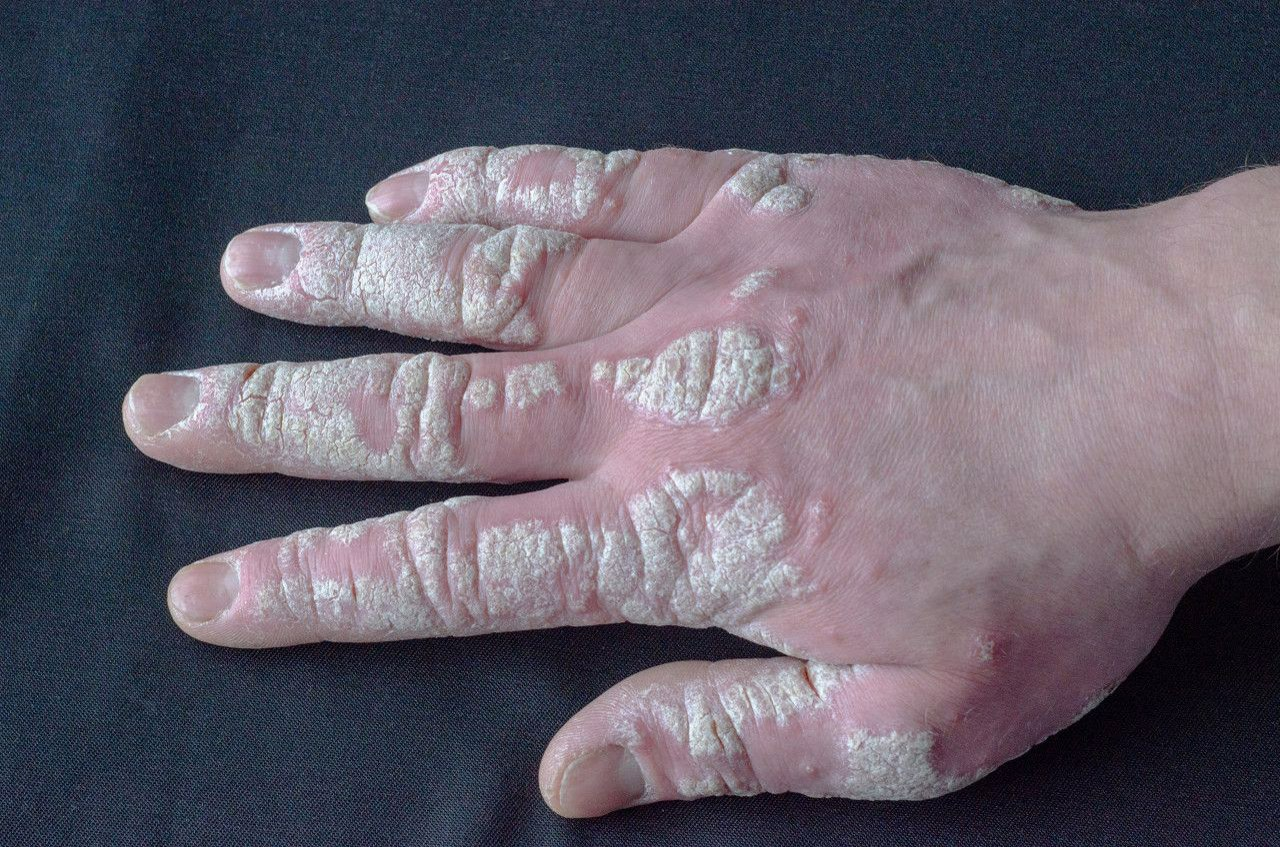 手指银屑病关节炎图片（手指关节银屑病怎么治疗）