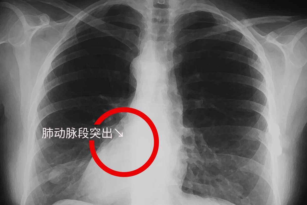 胸片肺动脉段突出图片（胸片 肺动脉段位置）