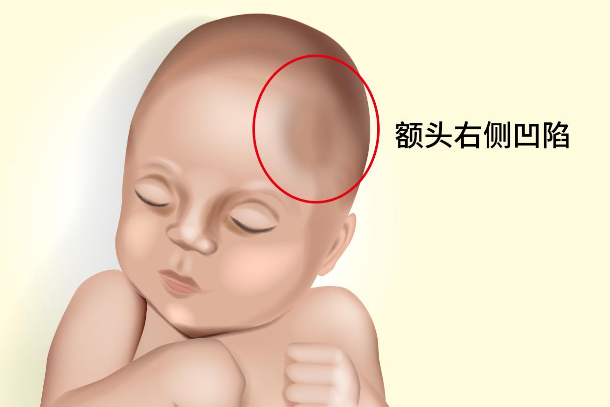 宝宝额头右侧凹陷图片（婴儿额头右边凹下去）
