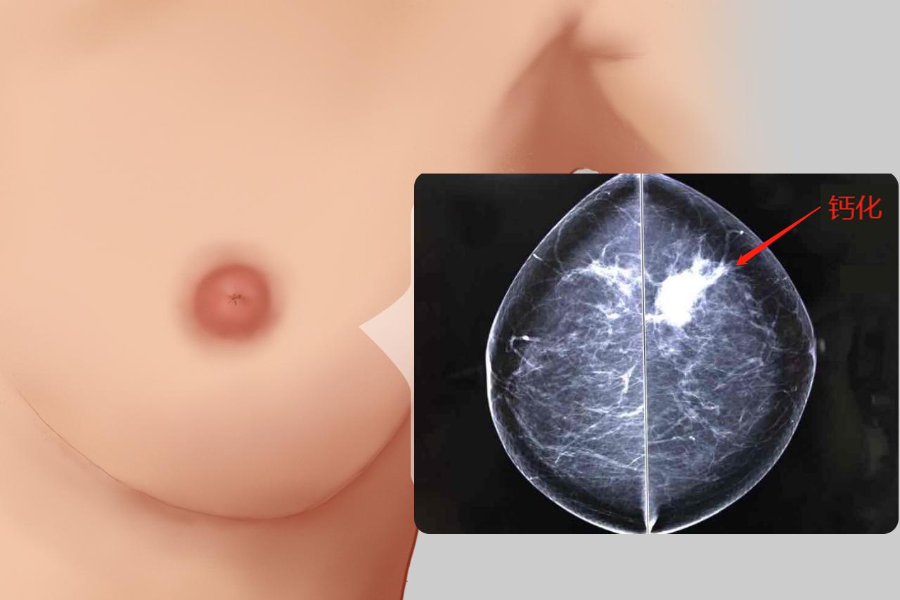 乳腺癌钙化图片 乳腺癌钙化图片高清