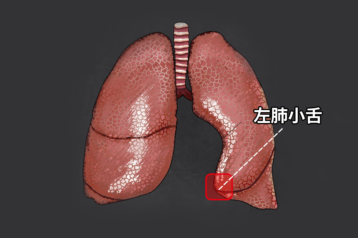 左肺小舌图片（左肺小舌位于a肺门b肺根c左肺膈面d左肺下缘e左肺前缘）