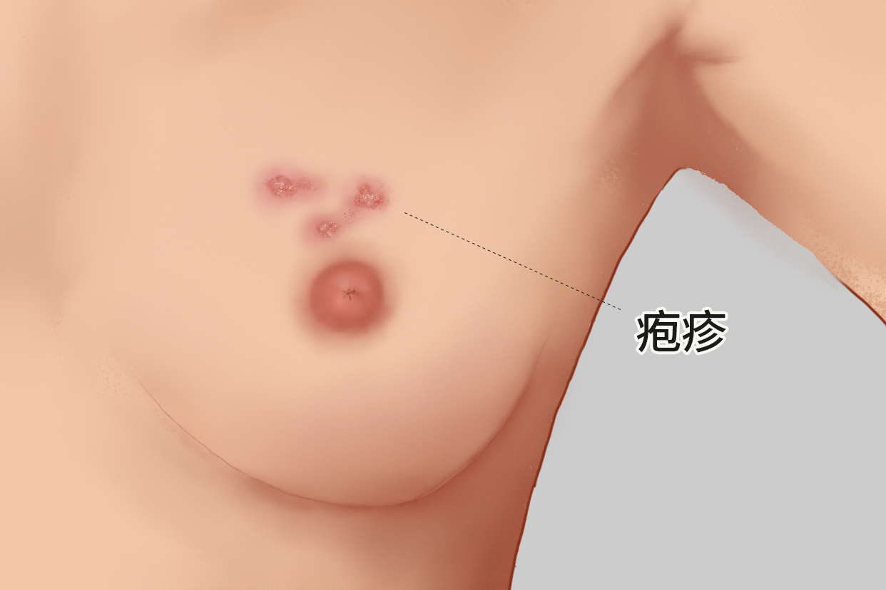 女性乳房长疱疹图样（女性乳房疱疹是什么引起的）