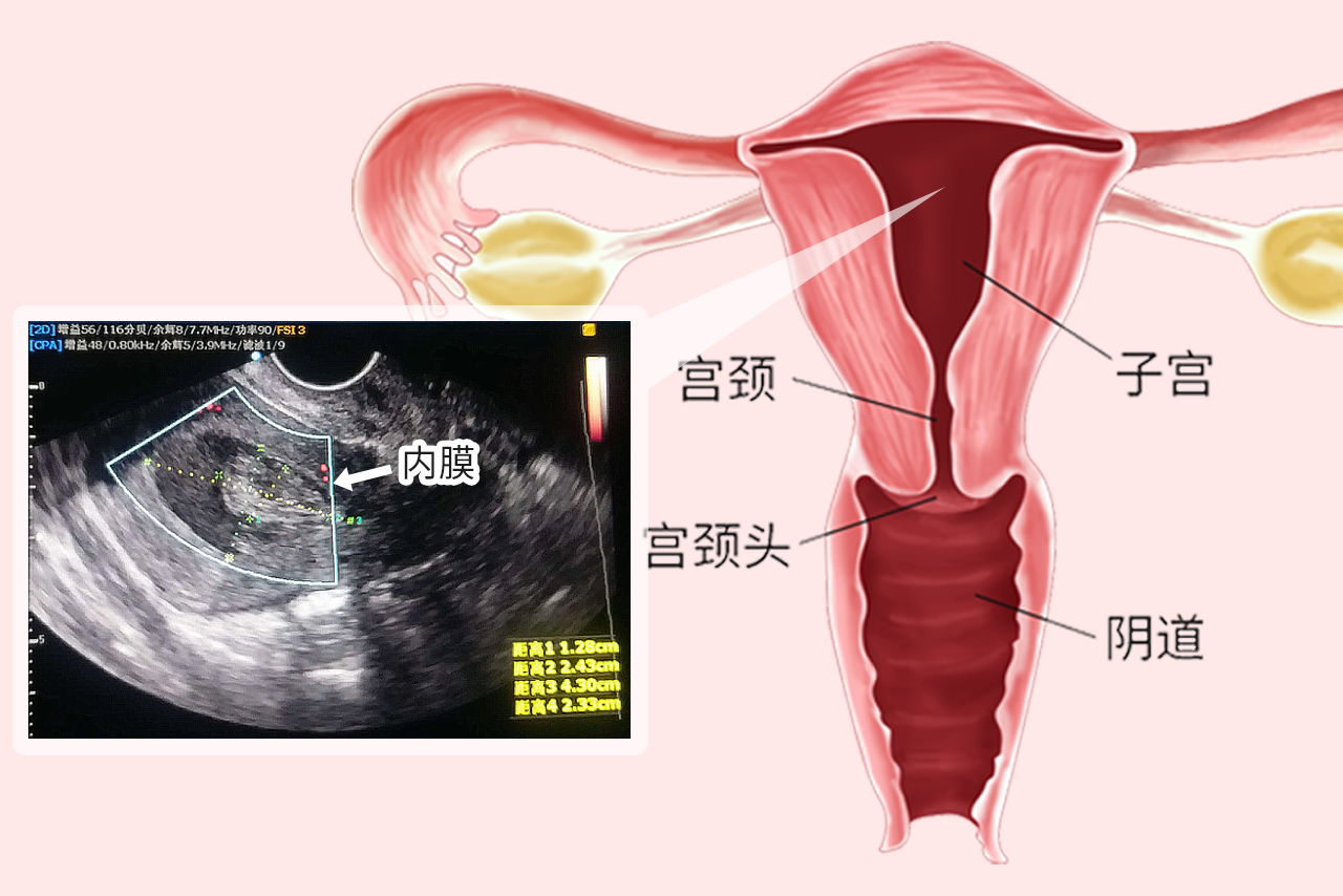 子宫内膜彩超图解