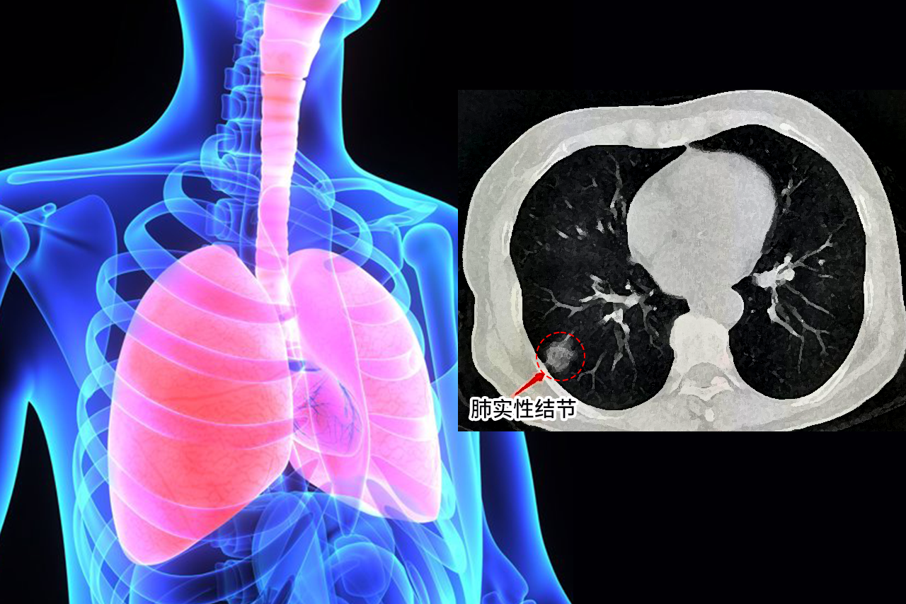 肺实性结节图片
