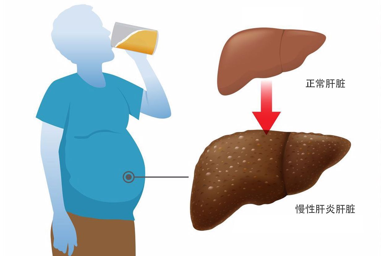 慢性肝炎图片