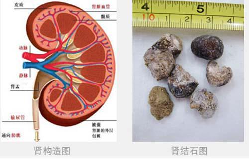 肾结石需要做手术吗（肾结石需要做手术吗?）