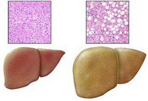 怎么预防脂肪肝 怎么预防脂肪肝的发生