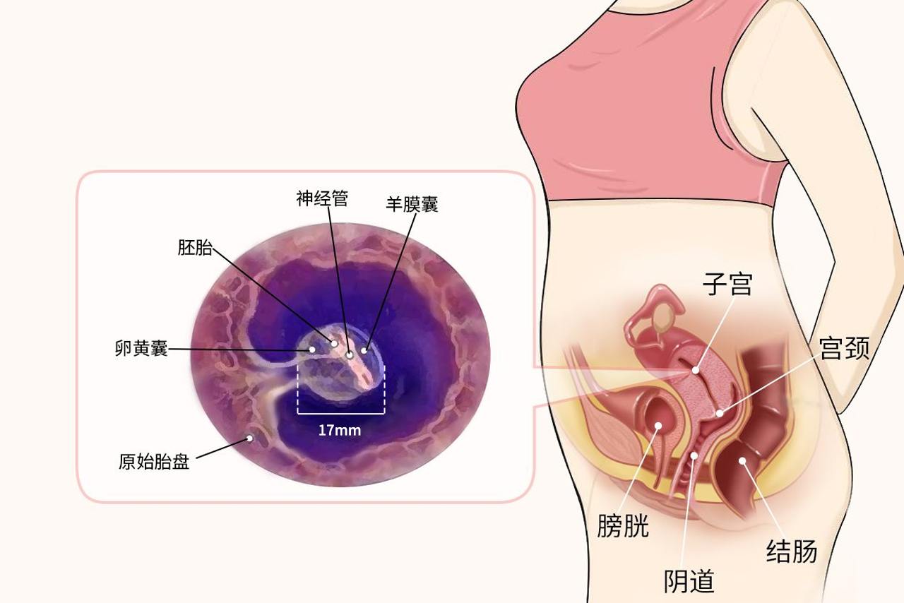 17mm孕囊有多大图片 孕囊直径17mm