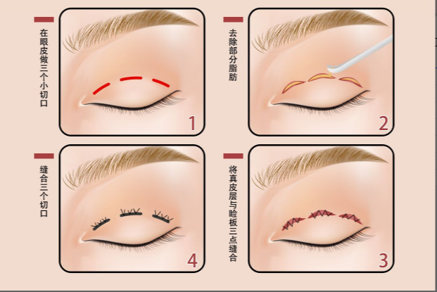 三点微创双眼皮图片