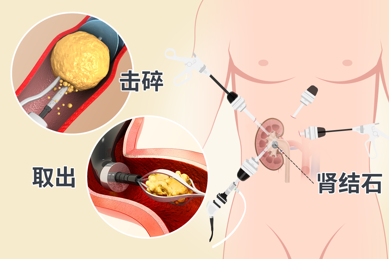 肾结石微创手术过程图