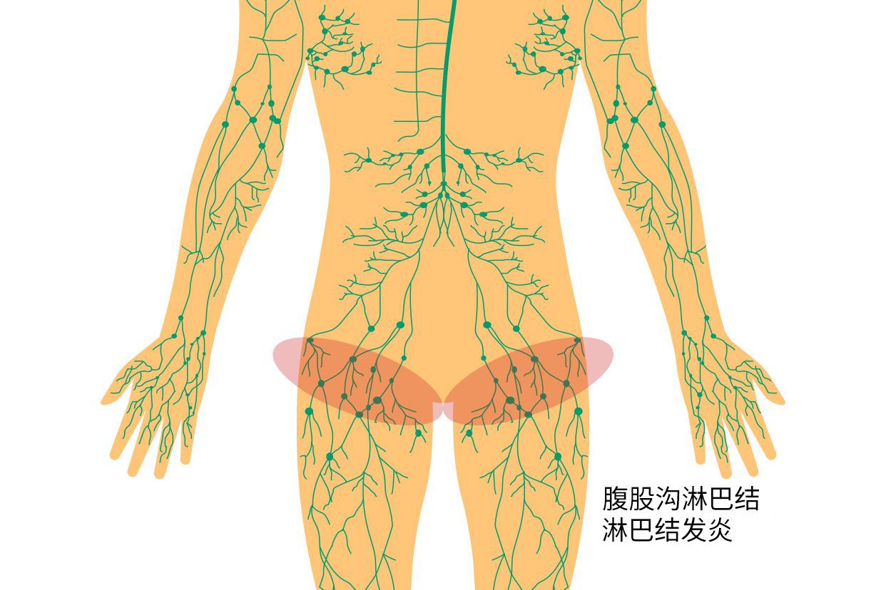 胯骨淋巴结发炎示意图