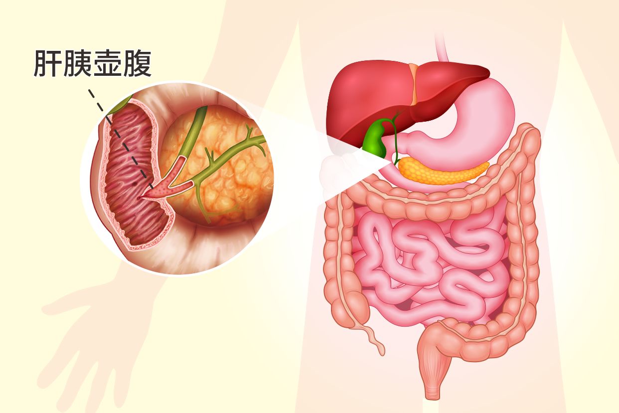 肝胰壶腹部在哪个位置图片 胆胰壶腹部在哪个位置图片