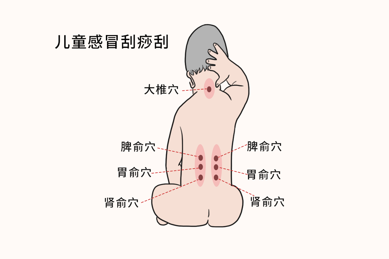 儿童感冒刮痧刮哪里图解