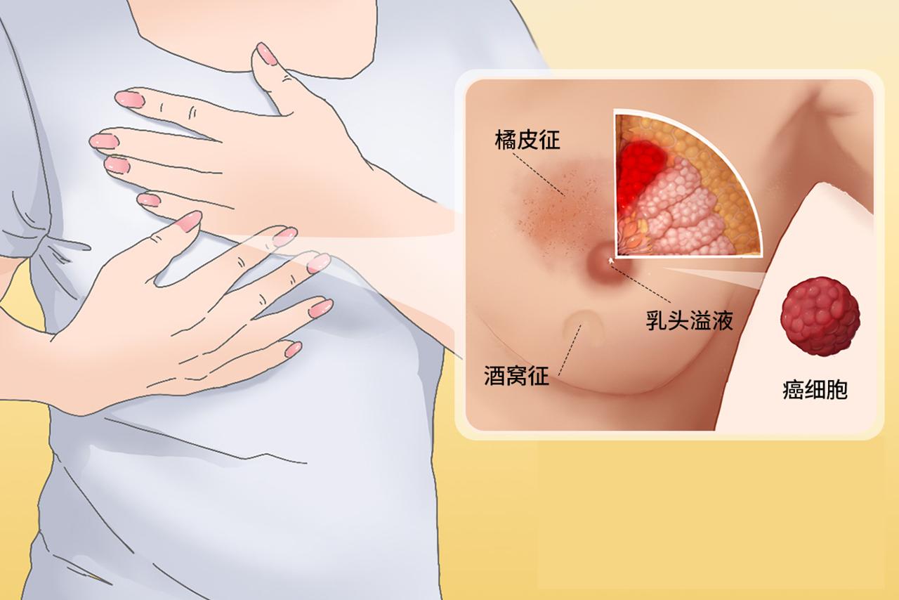 乳腺癌照片能检查出来吗